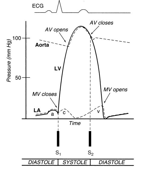 Wiggers Diagram Aortic Regurgitation