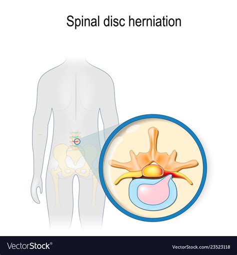 Spinal Disc Herniation Clipart Vector Graphics Spinal Disc The Best