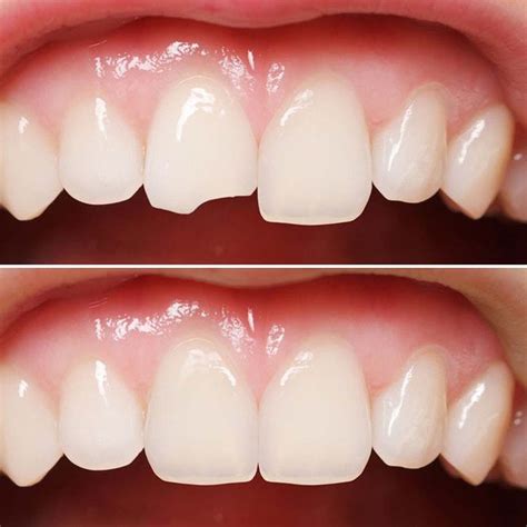 Heres How You Can Fix Your Chipped Tooth With Cosmetic Dentistry At