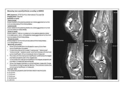 Kimriss Reader Rules For Assessment Of Knee Synovitiseffusion