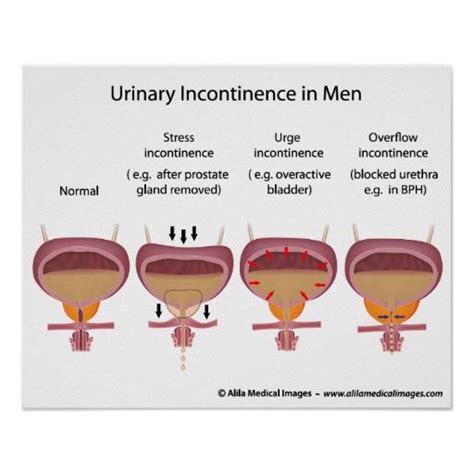 Male Urinary Incontinence Medical Blog