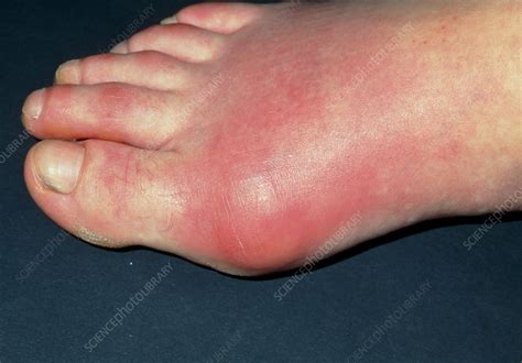 Inflamed Toe Joint In Patient With Gout Stock Image M1650128