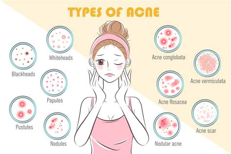 Different Types Of Acne Explained Vrogue Co