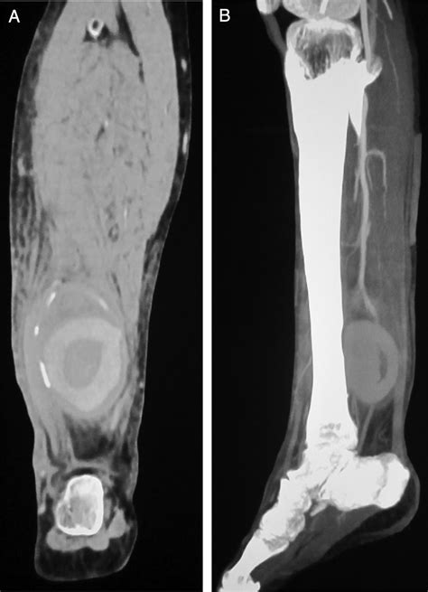 Pseudoaneurysm Of The Posterior Tibial Artery After Posterior Tibial