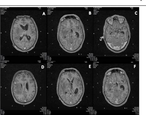 Figure 1 From Cerebral Toxoplasmosis Diagnosed By Stereotactic Brain