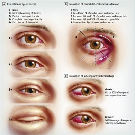 Differences In Postoperative Eyelid Edema Periorbital Ecchymosis And