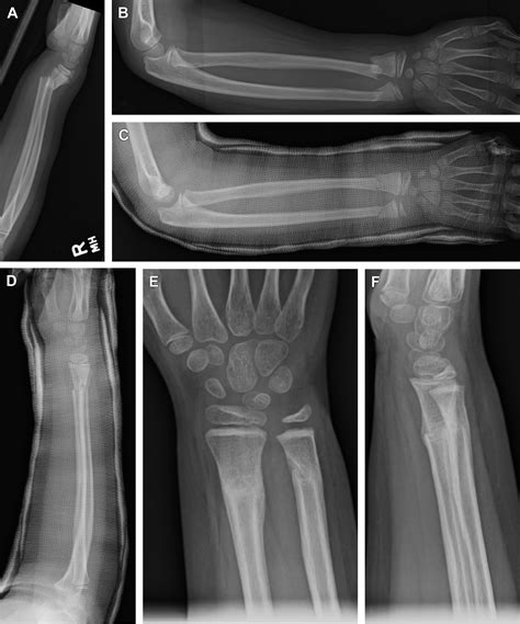 Fractured Ulna With Dislocation Of Radius Clipart Etc Images And