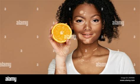 Beauty Skin Care Woman With Problem Skin Holds Orange Near A Face