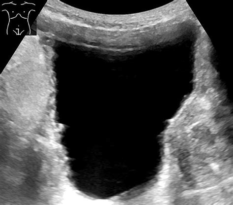 Ultrasound Of The Urinary Bladder Of An 85 Year Old Man It Shows A