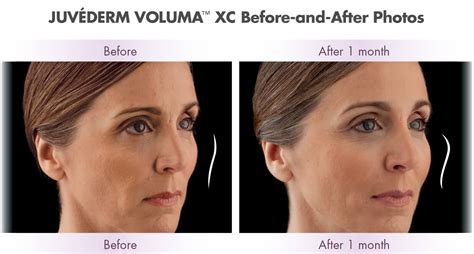 Voluma Results Cosmetic Surgery In Virginia Beach Va Virginia