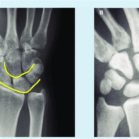 A Hook Of Hamate Fracture Carpal Tunnel View Radiograph Is