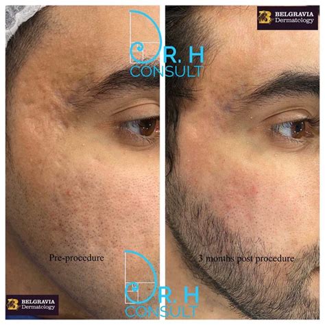 Acne Scar Laser Treatment Removal London Dr H Consult