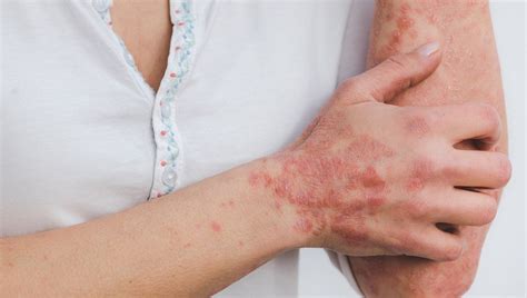 Even Severe Psoriasis Can Be Kept Under Control For A Long Time