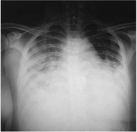 Chest X Ray Shows Bilateral Pulmonary Edema Download Scientific Diagram