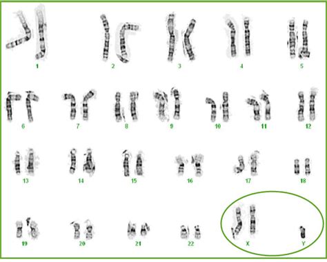 Dna X Chromosome 48 Xxyy Syndrome Is A Chromosomal Condition That Hot Sex Picture