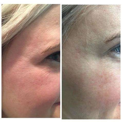 Pin By Urban Skin Rx On Dark Spots And Hyperpigmentation
