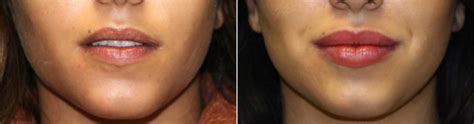 Lip Augmentation Photos Chevy Chase Md Patient 15005