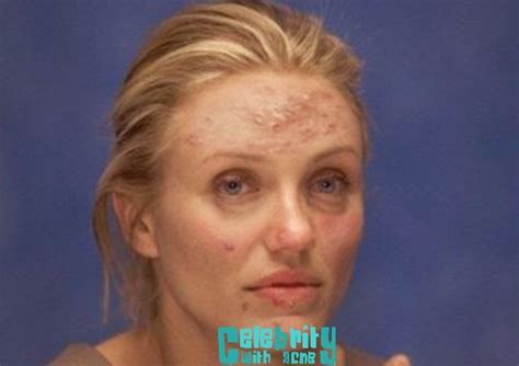 12 Ugly Celebrities Pictures Celebrity Acne Scars
