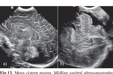 Neonatal Brain Ultrasound Anatomy