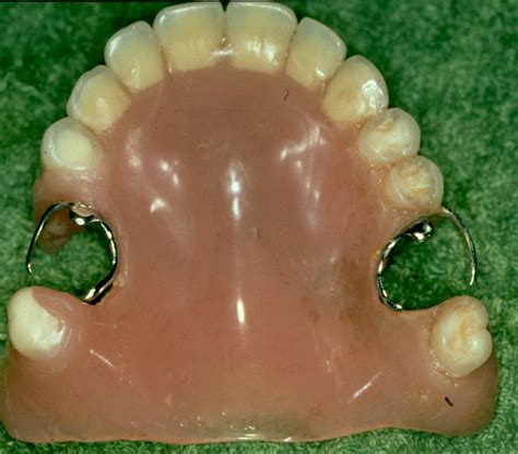 dentures in los algodones dental solutions