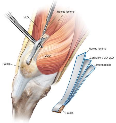 ACL Graft Selection SoFloPT SPORT Fort Lauderdale FL