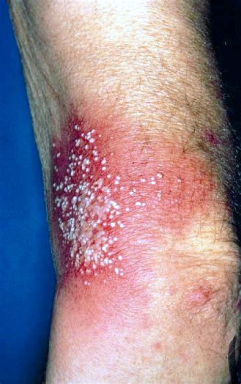Erythematous Plaques Studded With Sheets Of Pustules Pustular