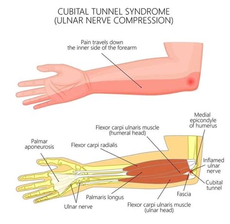 Carpal Tunnel Syndrome Medizzy