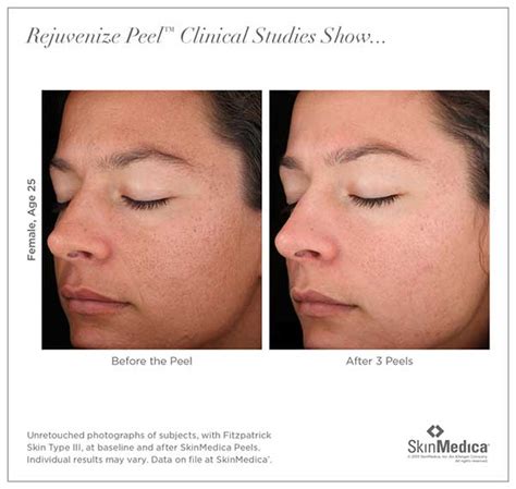 Facial Chemical Peels Before And After Photos View Now Garcia Plastic