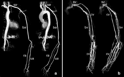 Example Of Selective Ce Mra Of Upper Extremity Arteries A And Veins