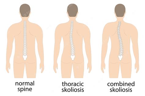 Premium Vector Vector Illustration Of Spinal Deformity Kyphosis