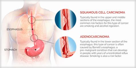 Esophageal Cancer Types Risk Factors Symptoms Diagnosis Treatment Hot