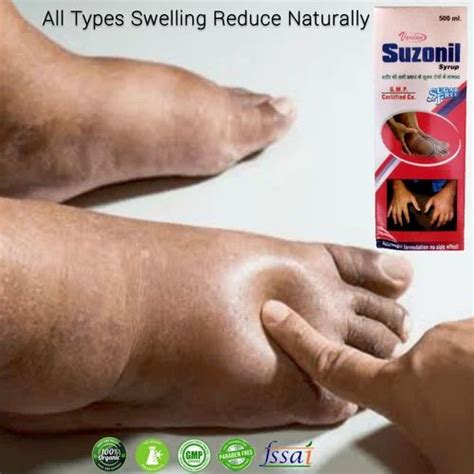 Medicine For Swelling 500ml At Rs 350bottle In Surat Id 2849223487048