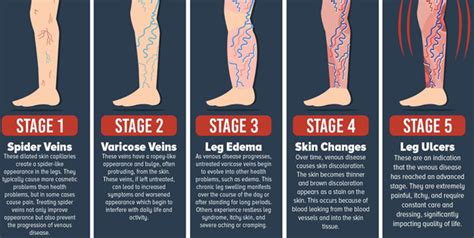 Treat Varicose Veins On Time To Avoid Serious Complications Onlymyhealth