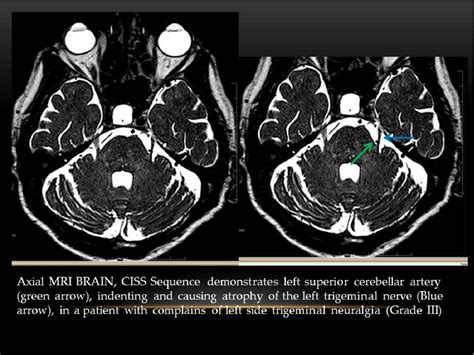 Mri Scan Of Trigeminal Nerve Mri Scan Trigeminal Neuralgia Cranial