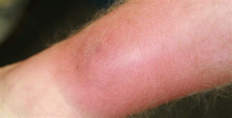 Cellulitis Skin Infection Causes And How Do To Treat
