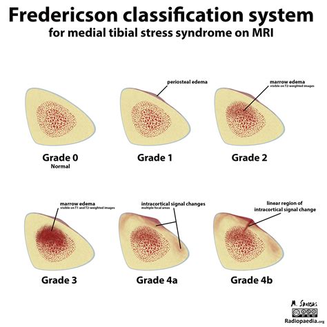 Fredericson Mri Classification Of Medial Tibial Stress Syndrome Image