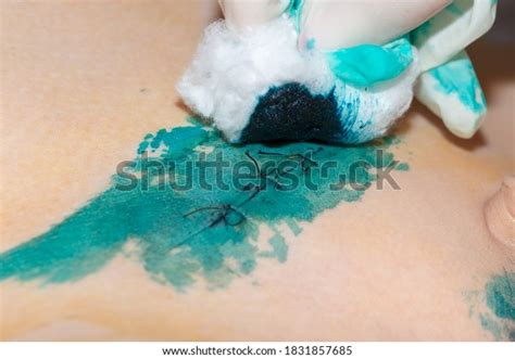 Sutured Wound Smears Brilliant Green After Stock Photo 1831857685