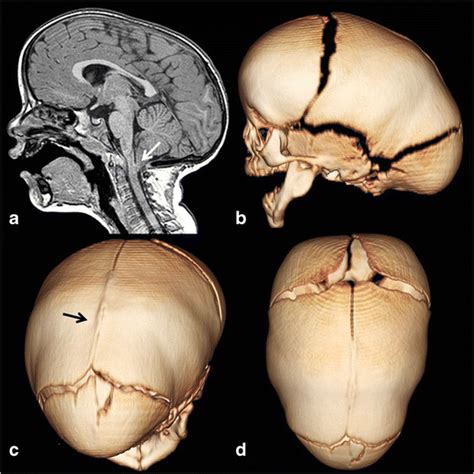 Skull Base Development And Craniosynostosis Springerlink