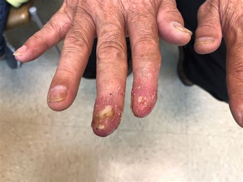 Derm Dx Painful Recurrent Rash On The Fingers Dermatology Advisor