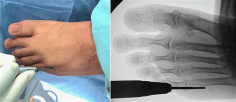 Sliding Distal Metatarsal Minimally Invasive Osteotomy With An