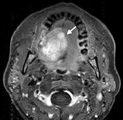 Malignant Mixed Tumor Of The Hard Palate Airp Best Cases In Radiologic
