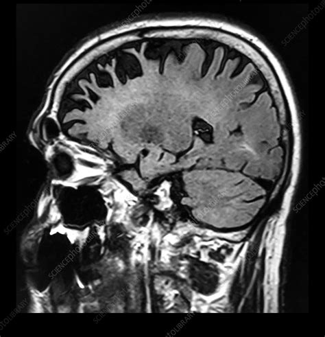 Frontal Temporal Dementia Mri Stock Image C0394114 Science