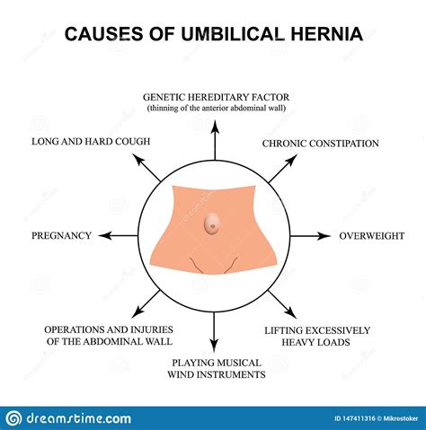 Umbilical Hernia Vector Illustration 61124246