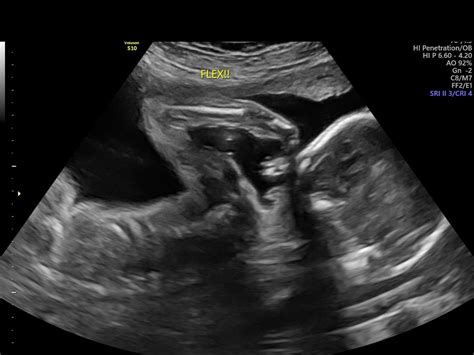 【ベストコレクション】 24 Weeks Pregnant Ultrasound Gender 220010 24 Weeks