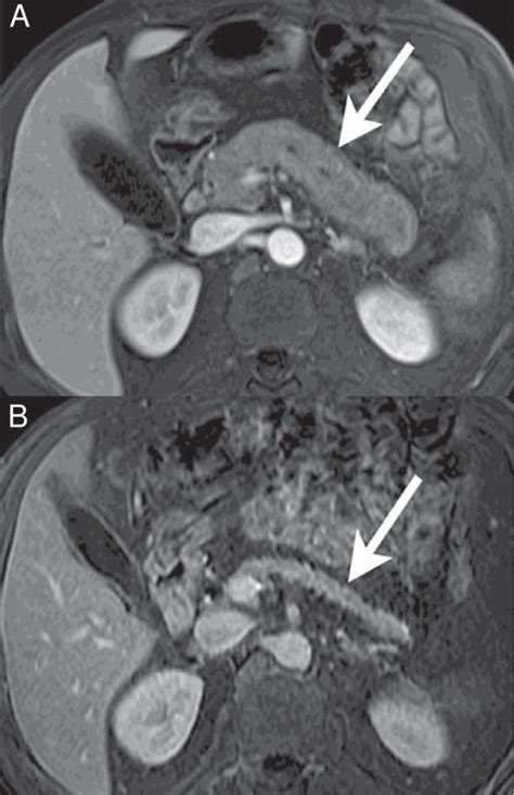 Post Therapeutic Pancreatic Atrophy A Axial Contrast Enhanced T1