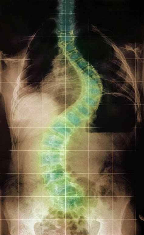Scoliosis In Sotos Syndrome Photograph By Dr P Marazziscience Photo