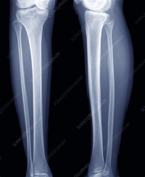 Normal Lower Legs X Ray Stock Image F0027553 Science Photo Library