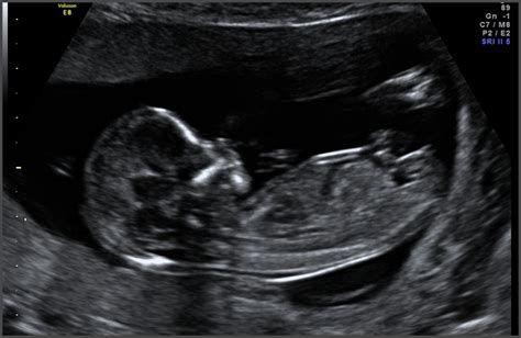 Baby Gender Ultrasound Near Me Get More Anythinks