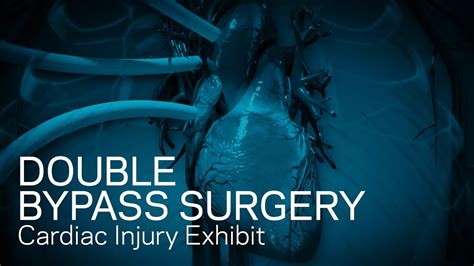 Double Bypass Surgery Cardiac Injury Exhibit Youtube