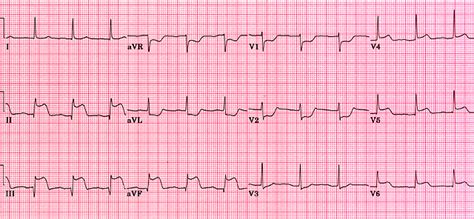 Similar ecg signs are not specific, but with their help it is possible to find out the localization of the inflammatory focus. Acute posterior MI